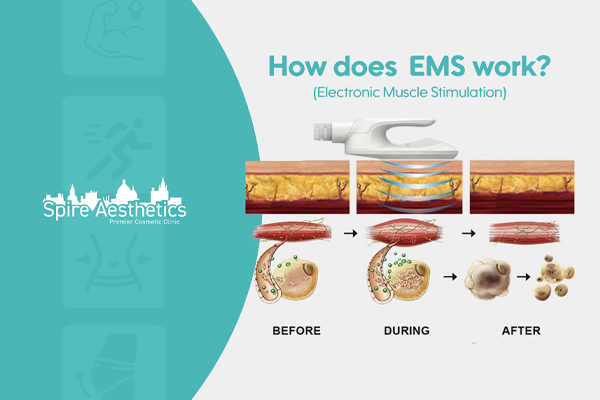 EMS treatment for post pregnancy weight loss treatment Kensington and Chelsea