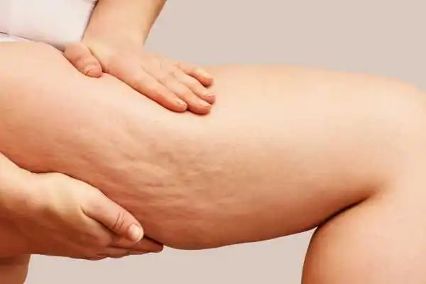 Image of woman showing leg with cellulite Kensington and Chelsea