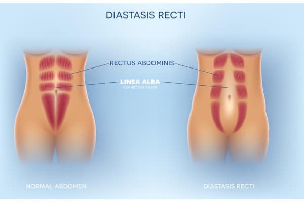 What Non-Surgical Options Are Available for Diastasis Recti Kensington and Chelsea?
