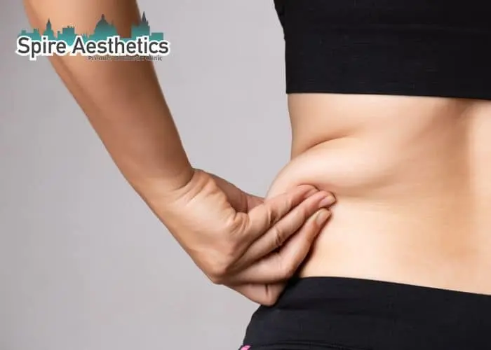 Image of woman pinching fat on their hips Kensington and Chelsea. Fat Freezing treatment
