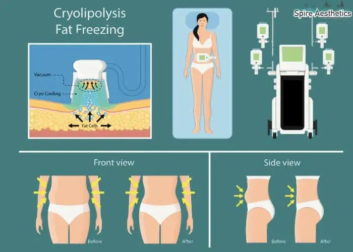 Fat freezing treatment Kensington and Chelsea benefits for competitions to remove stubborn fat deposits.
