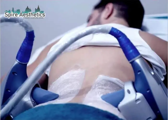 Man having fat freezing treatment done on love handles before a competitions Kensington and Chelsea to create a sculpted look.