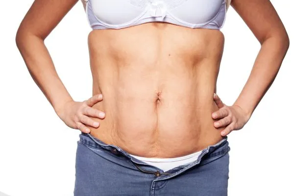 sagging skin on woman's stomach after weight loss injections Kensington and Chelsea