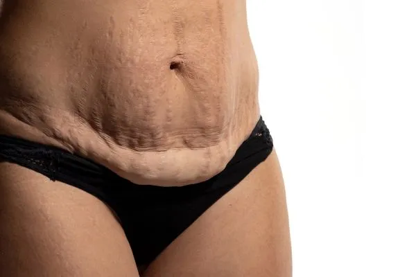 Image of womans stomach after weight loss injections Kensington and Chelsea showing saggy skin