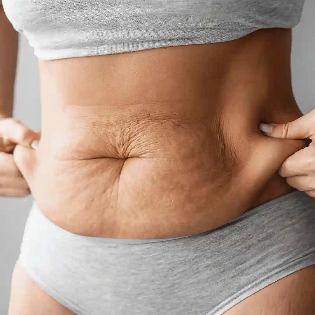 Is It Normal to Have Loose Skin After Pregnancy Kensington and Chelsea?