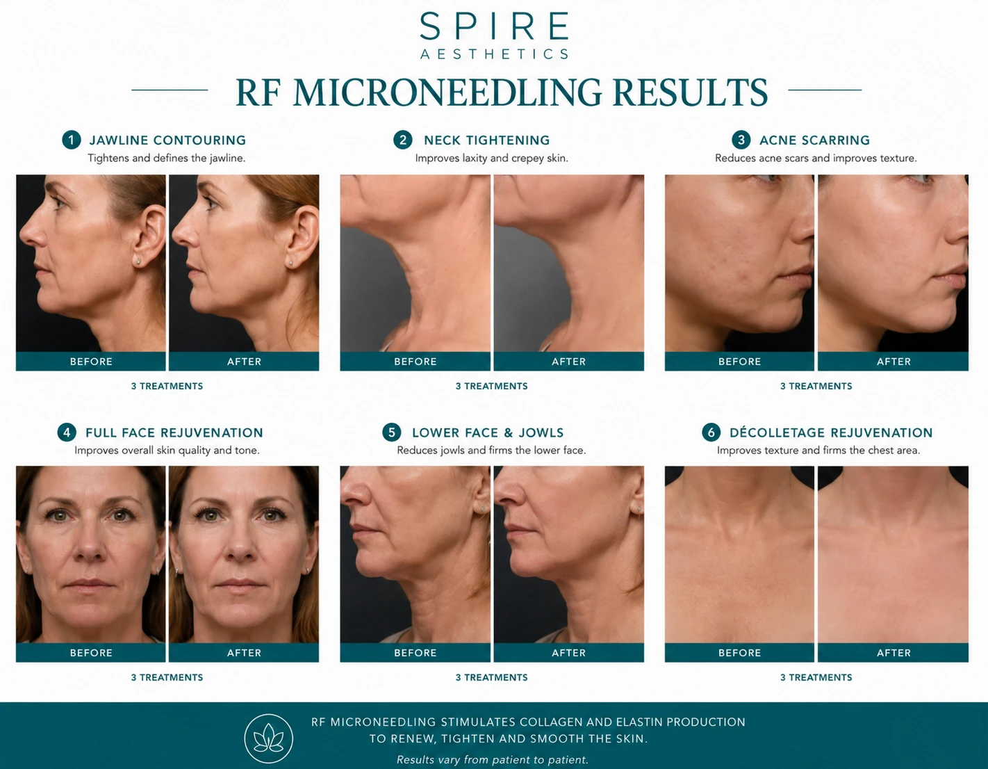 RF Microneedling Skin tightening Kensington and Chelsea results