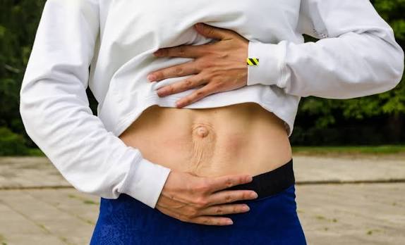 When Could Diastasis Recti Be the Missing Piece of the Puzzle Kensington and Chelsea?
